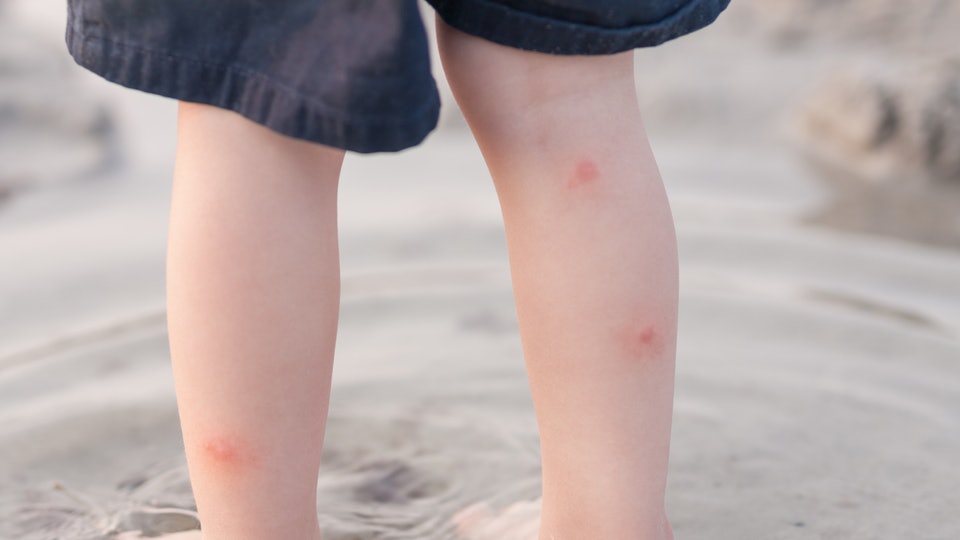 No More Itching!