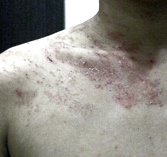 Culebrilla