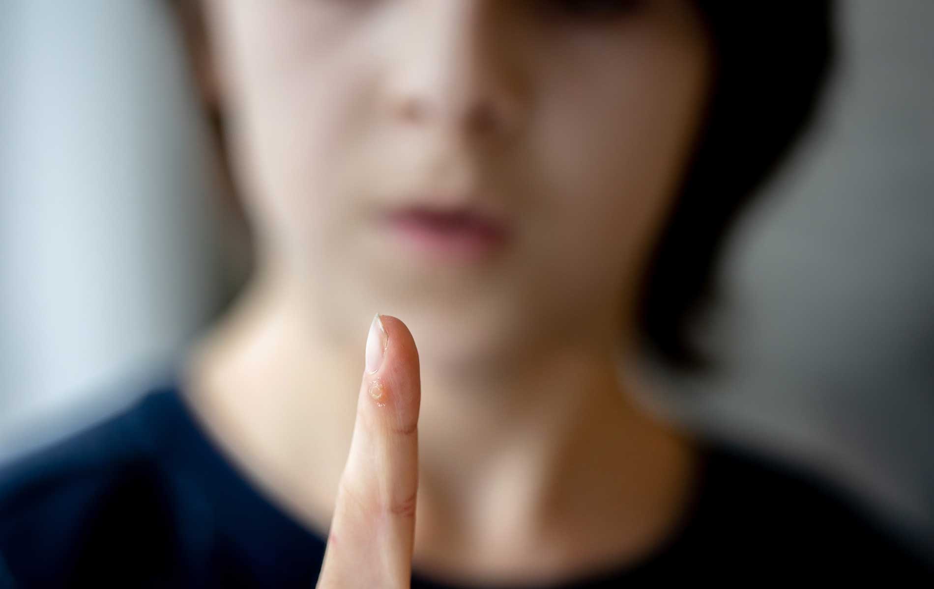 Warts Uncovered