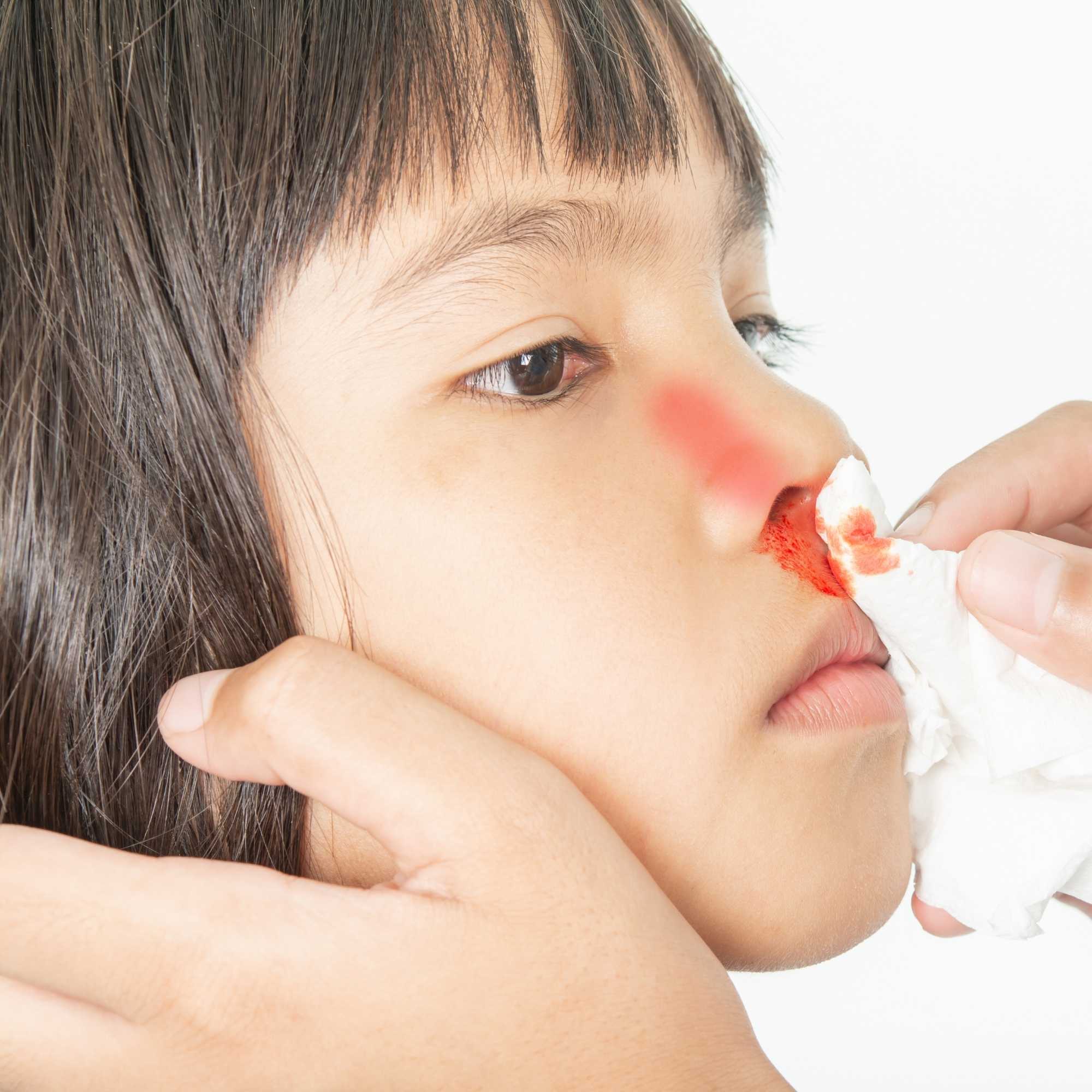 Nosebleeds in Kids: What’s Normal and When to Seek Care