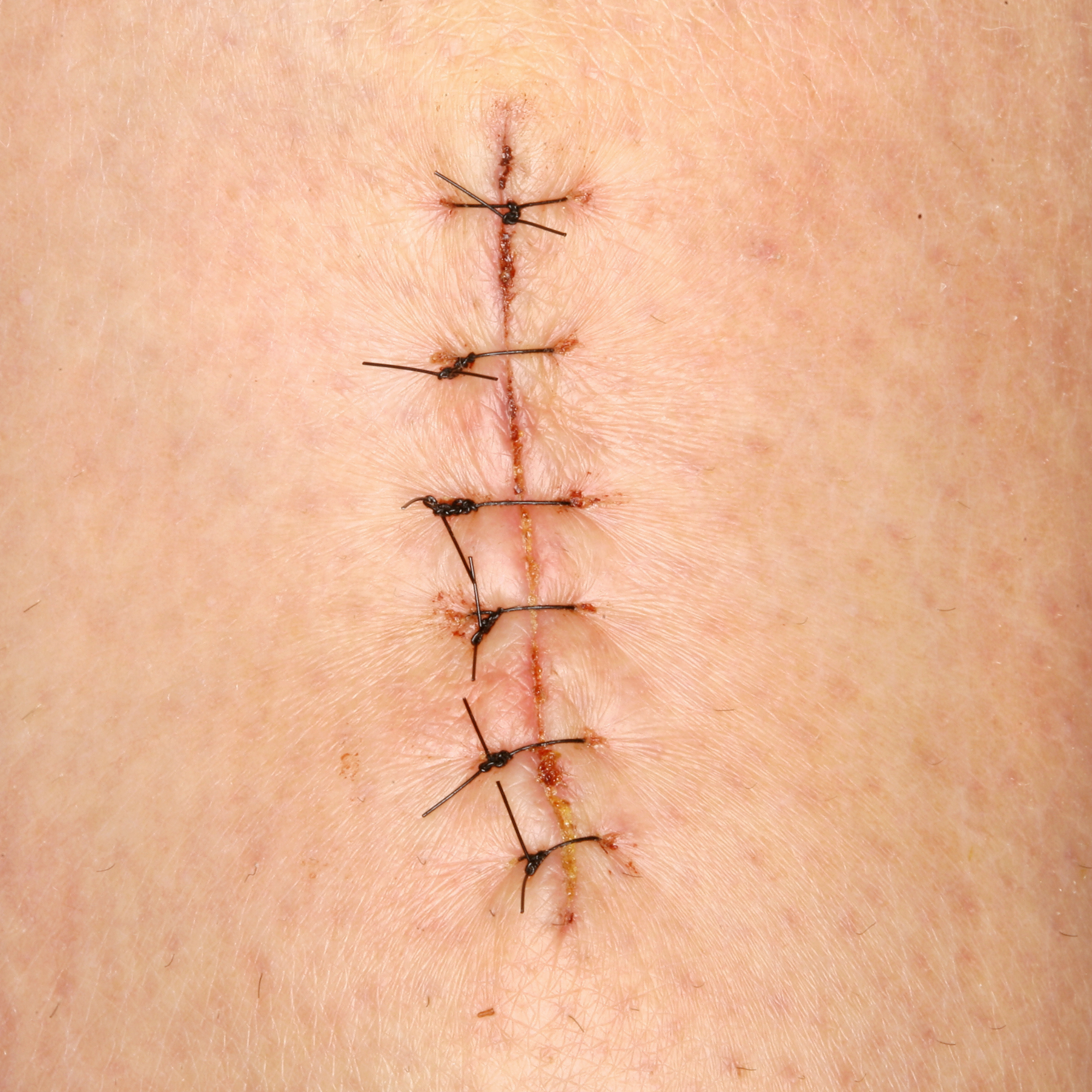 Can Urgent Care Do Stitches? When to Go vs ER | HealthCARE Express