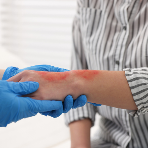 How to Treat a Burn at Home | When to Seek Urgent Care