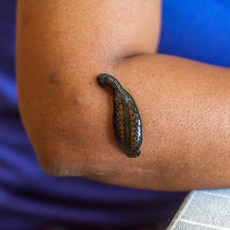 High Blood Pressure Treatment: From Leeches to Today